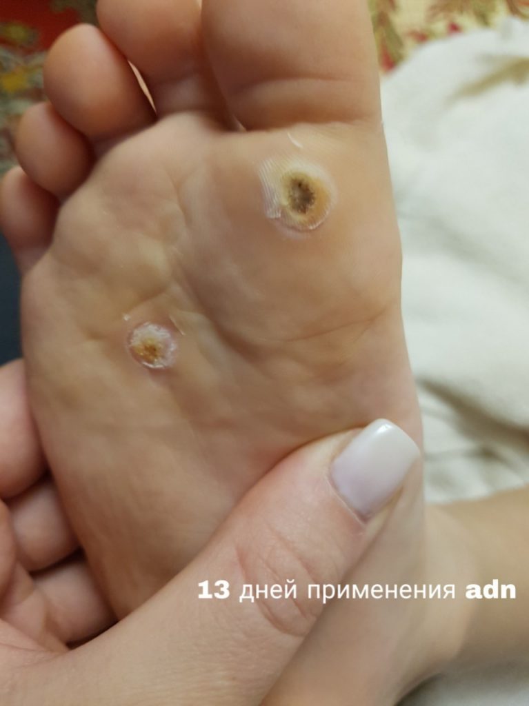 Как избавиться от бородавок на ногах и руках. Как удалить бородавку ...