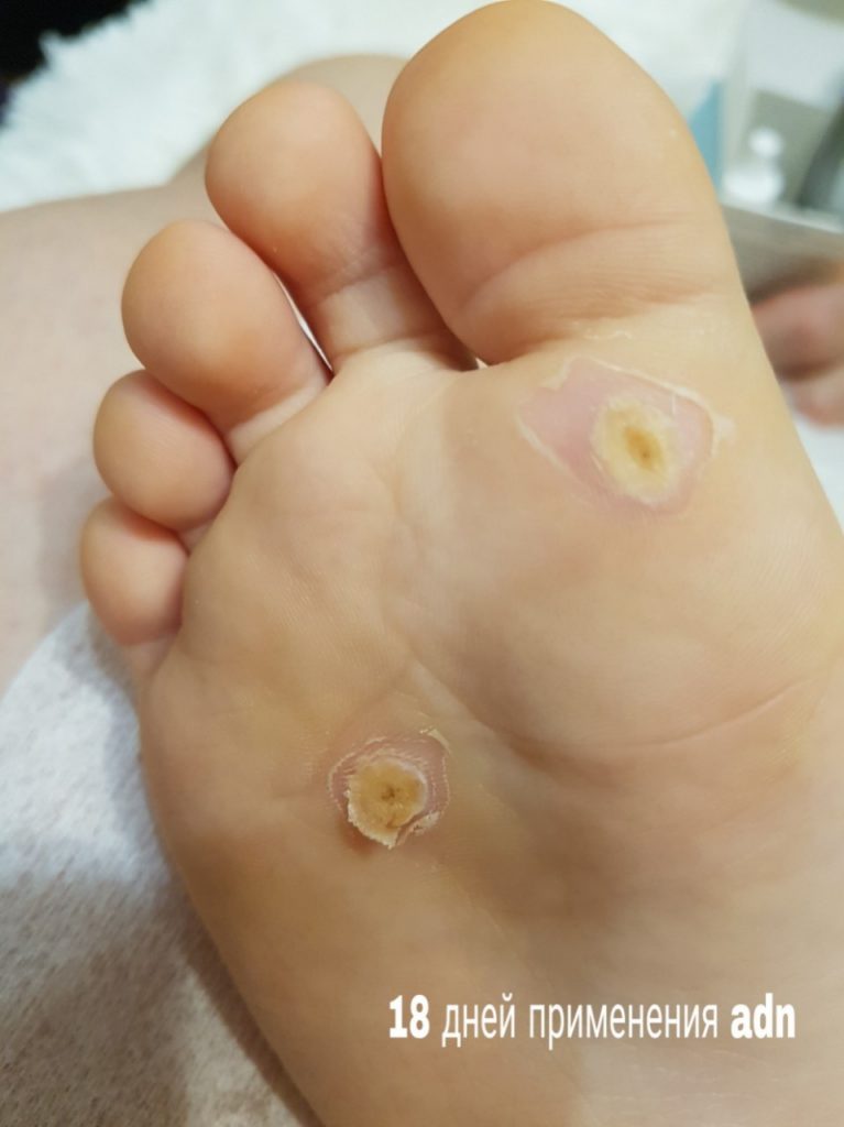 Как избавиться от бородавок на ногах и руках. Как удалить бородавку ...